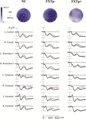 Cognitive Deficits and Associated ERP N400 Abnormalities in FXTAS With Parkinsonism